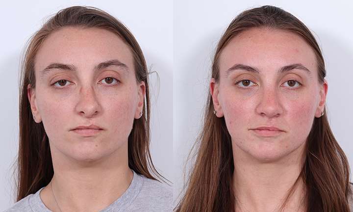 Scar Revision Before and After Photo by Dr. Cleveland in West Palm Beach Florida