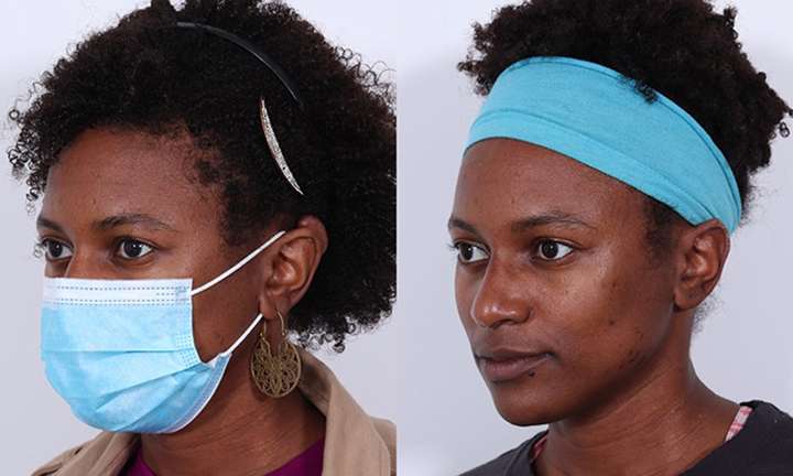 Scar Revision Before and After Photo by Dr. Cleveland in West Palm Beach Florida scaled