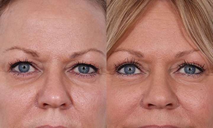 Blepharoplasty Before and After Photo by Dr. Cleveland in West Palm Beach Florida