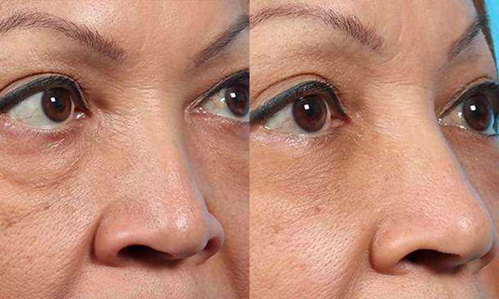 Blepharoplasty Before and After Photo by Dr. Cleveland in West Palm Beach Florida