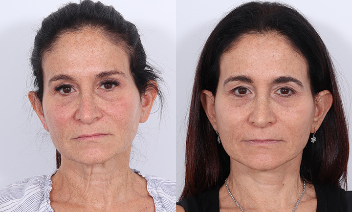 Facelift Before and After Photo by Dr. Cleveland in West Palm Beach Florida