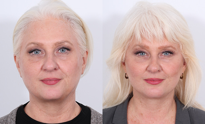 Facelift Before and After Photo by Dr. Cleveland in West Palm Beach Florida