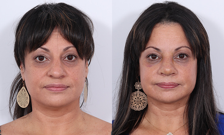 Rhinoplasty Before and After Photo by Dr. Cleveland in West Palm Beach Florida