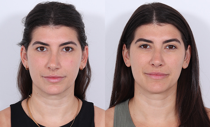Rhinoplasty Before and After Photo by Dr. Cleveland in West Palm Beach Florida