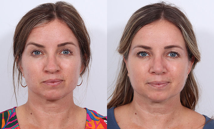 Rhinoplasty Before and After Photo by Dr. Cleveland in West Palm Beach Florida