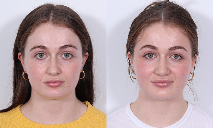 Rhinoplasty Before and After Photo by Dr. Cleveland in West Palm Beach Florida