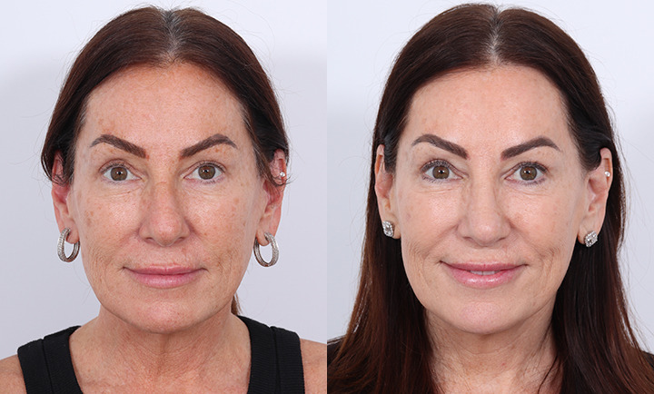 Rhinoplasty Before and After Photo by Dr. Cleveland in West Palm Beach Florida