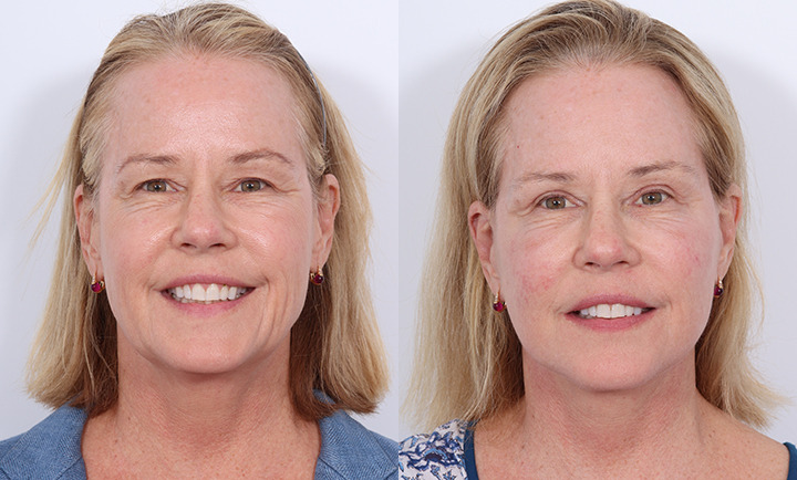 Facelift Before and After Photo by Dr. Cleveland in West Palm Beach Florida