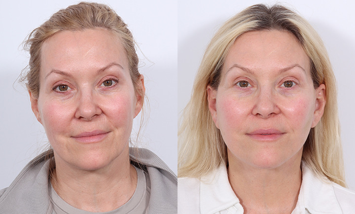 Facelift Before and After Photo by Dr. Cleveland in West Palm Beach Florida