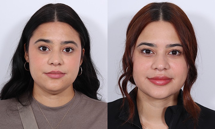 Front View Face Liposuction Before and After Photo by Dr. Patrick Cleveland