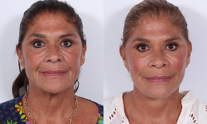Front View Facelift, Submentoplasty Before and After Photo by Dr. Cleveland pt