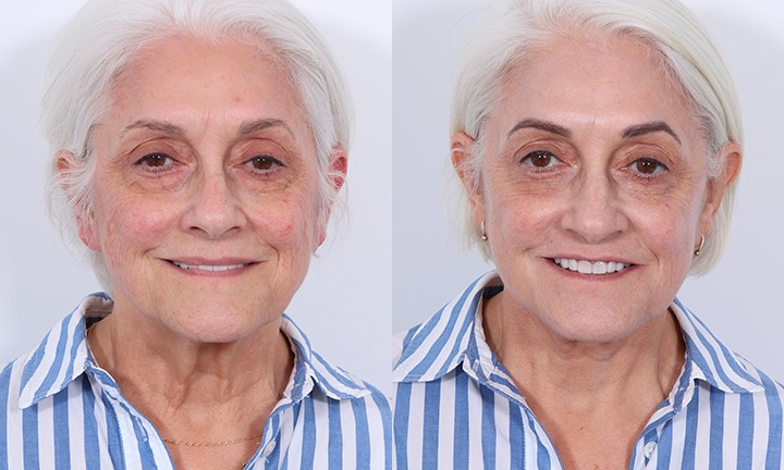 Front View Facelift, Submentoplasty Before and After Photo by Dr. Cleveland pt