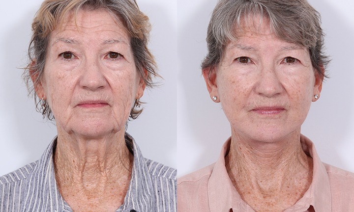 Front View Facelift, Submentoplasty Before and After Photo by Dr. Cleveland pt