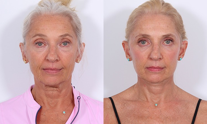 Front View Facelift, Submentoplasty Before and After Photo by Dr. Cleveland pt
