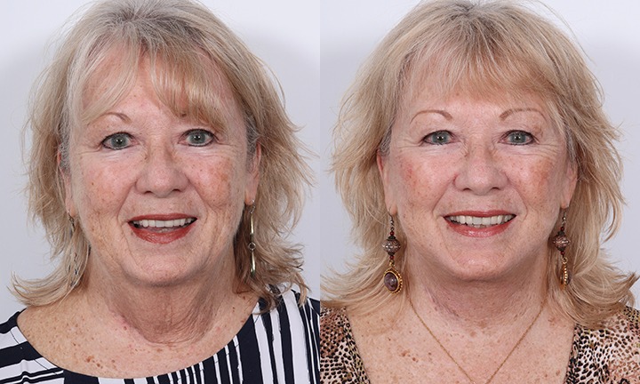 Front View Facelift, Submentoplasty, Submental Liposuction Before and After Photo by Dr. Cleveland pt