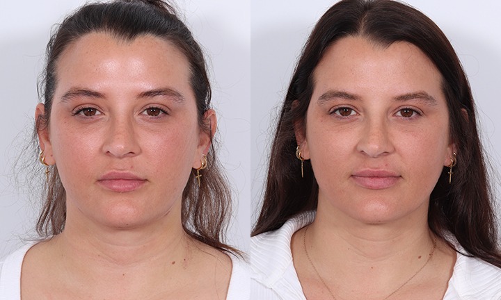 Front View Liposuction Before and After Photo by Dr. Cleveland pt