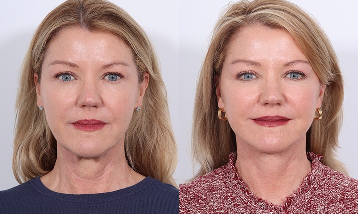 Front View Revision Facelift Before and After Photo by Dr. Cleveland pt