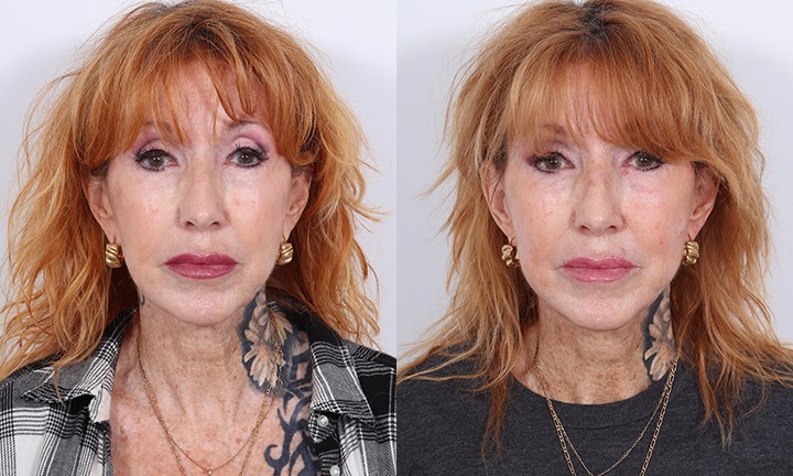 Front View Revision Facelift, Earlobe Reduction Before and After Photo by Dr. Cleveland pt