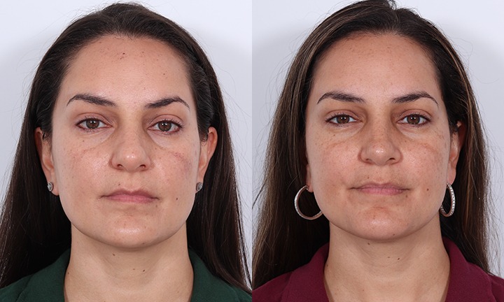 Front View Rhinoplasty Before and After Photo by Dr. Cleveland pt