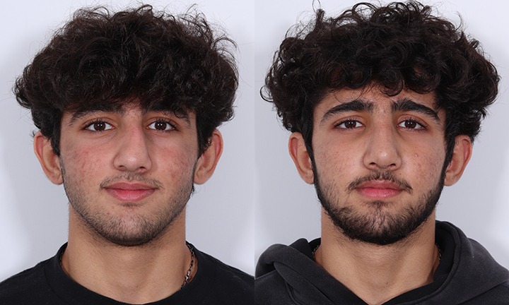 Front View Rhinoplasty Before and After Photo by Dr. Cleveland pt