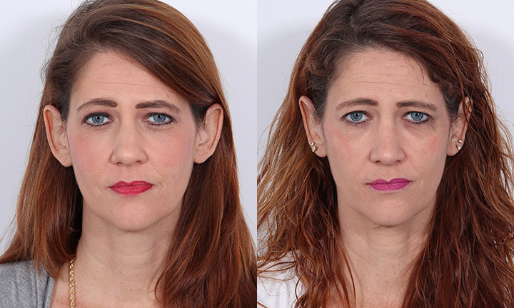 Front View Rhinoplasty & Otoplasty Before and After Photo by Dr. Cleveland pt