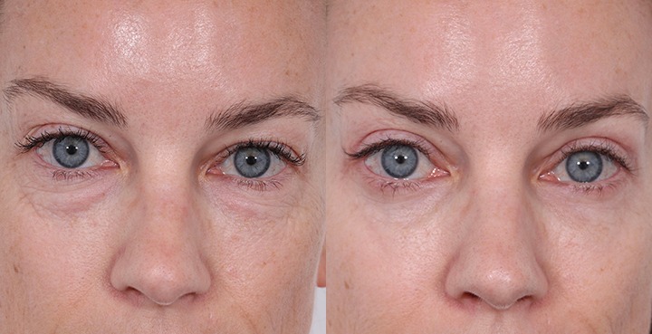Front View Upper and Lower Blepharoplasty Before and After Photo by Dr. Cleveland pt